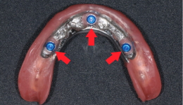 Locator Attachments on Denture to fix onto Bar